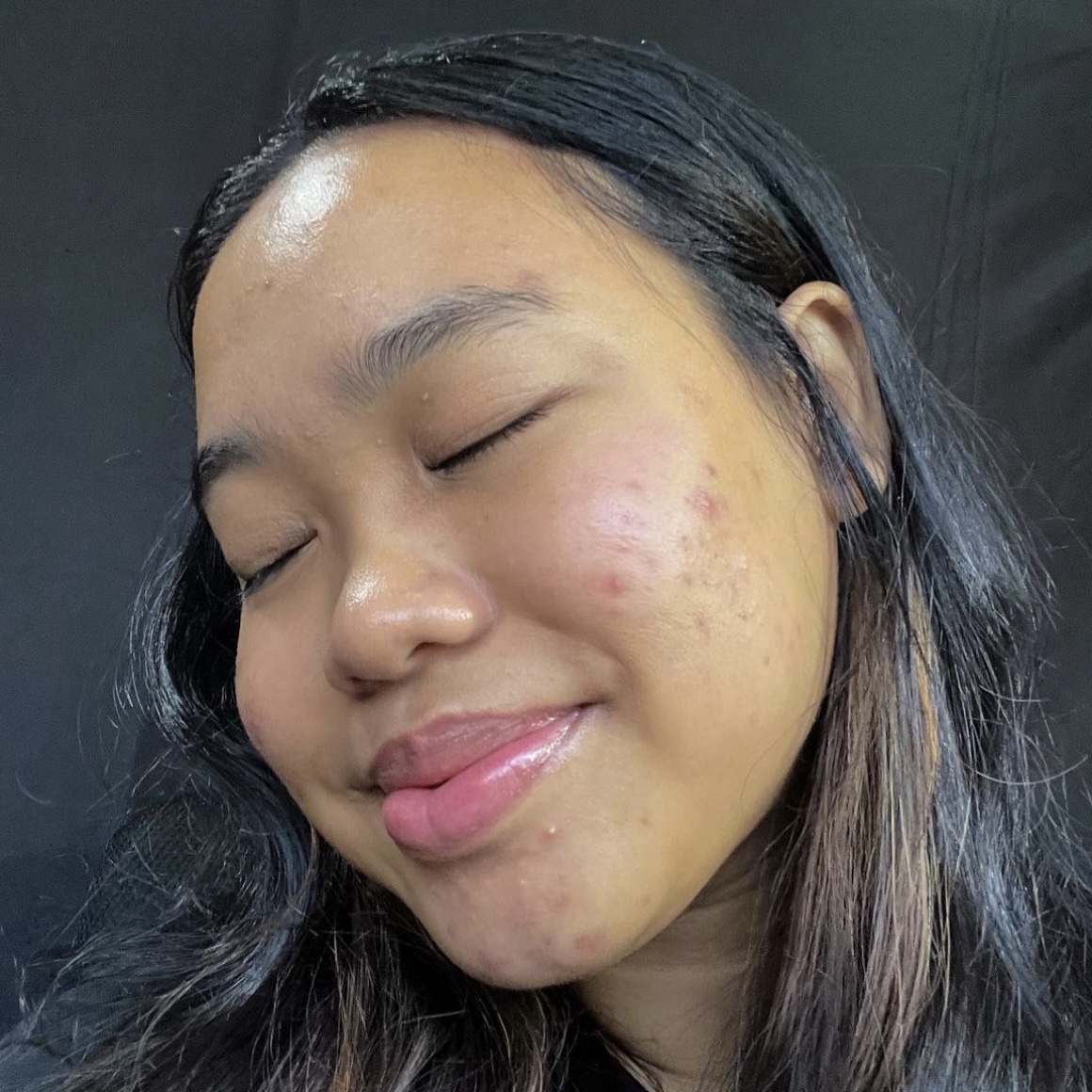 Defying Acne: A Courageous Journey to Self-Love