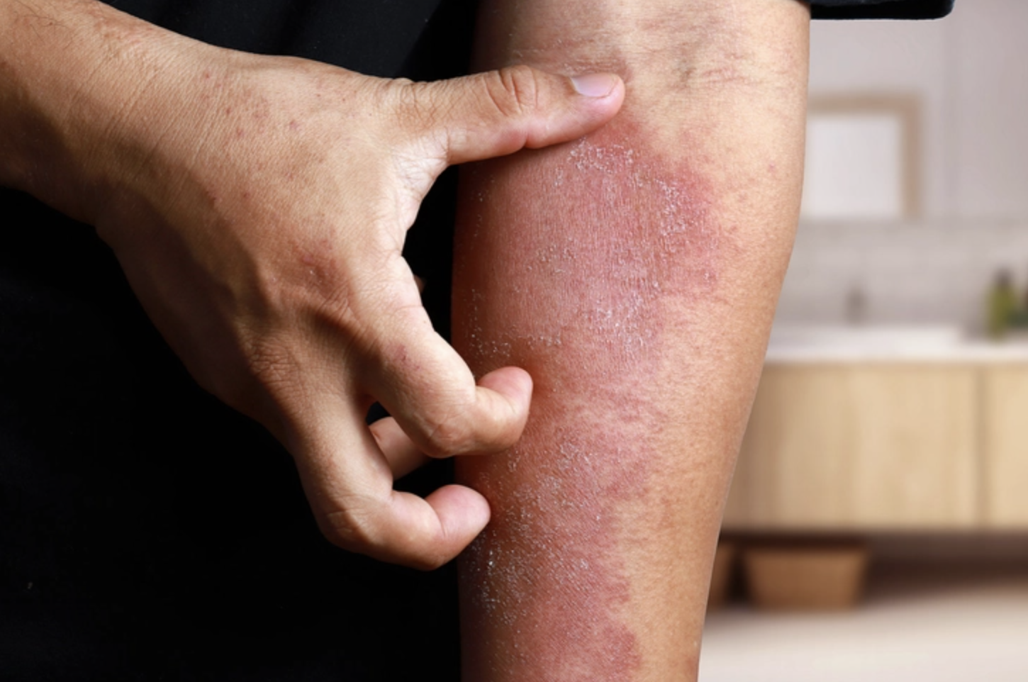 Pic 2. Eczema scratching Pet Sitter